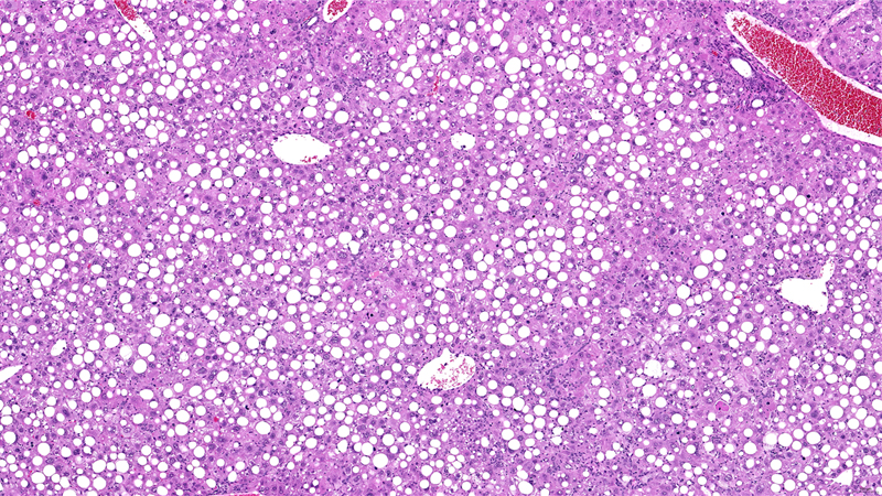 Liver Steatosis